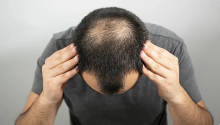 Minoxidil e calvície: combate à queda de cabelo com controvérsias; especialistas opinam